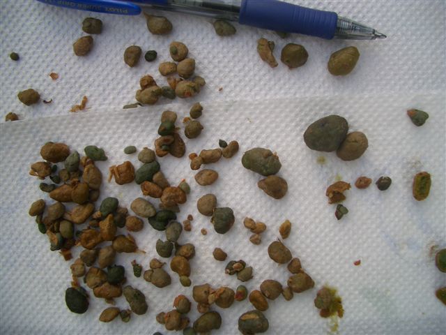 First Liver Flush Liver Stones or gallstones