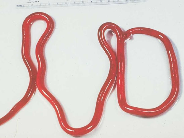 Click Here To See the NEXT image ( 64 ) ( Human Worms and other parasites ) 