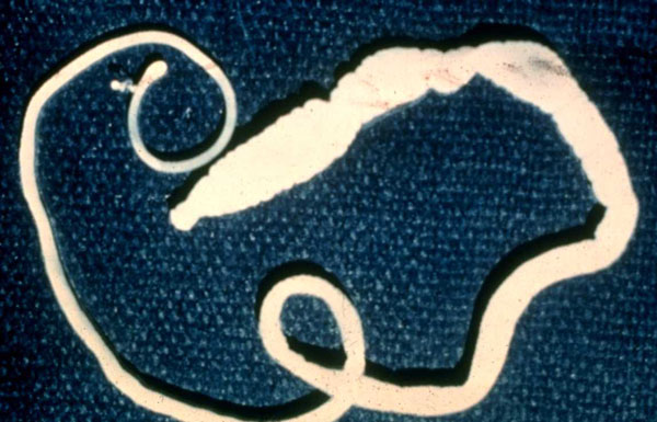 Click Here To See the NEXT image ( 0 ) ( Human Worms and other parasites ) 