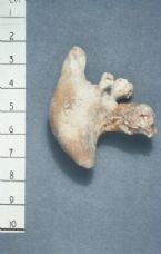 kidney stone 3 ... (Click to enlarge)