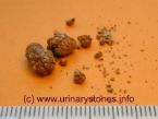 kidney stones urinary stones ... (Click to enlarge)