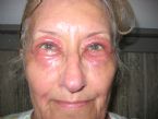 eye rash ... (Click to enlarge)