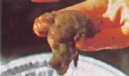 Mucoid Plaque. Photo from Dr. Jensen's  Bowel Management Book ... (Click to enlarge)