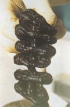 Mucoid Plaque. Photo from Dr. Jensen's  Bowel Management Book ... (Click to enlarge)