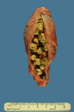 gallbladder_removed ... (Click to enlarge)